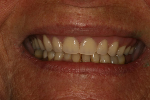 Dentures After