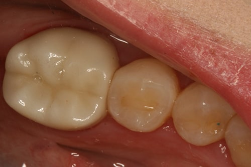 Crowns After
