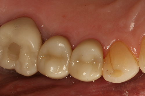 Crowns After
