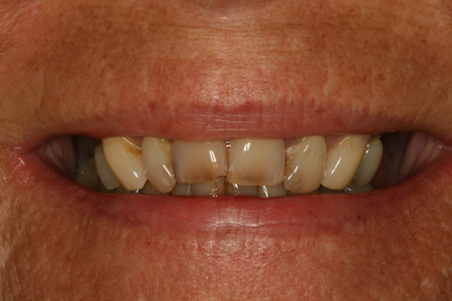 Dentures Before